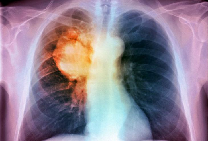 Sanità, approvato il percorso diagnostico terapeutico assistenziale per il tumore del polmone
