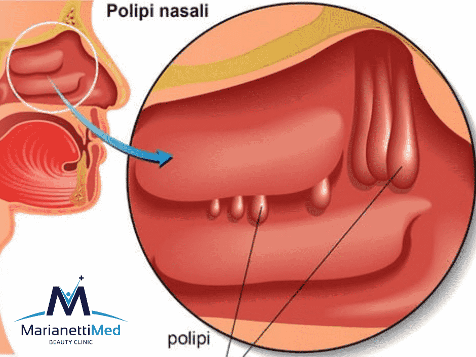 Otorino Avezzano: come curare i polipi nasali
